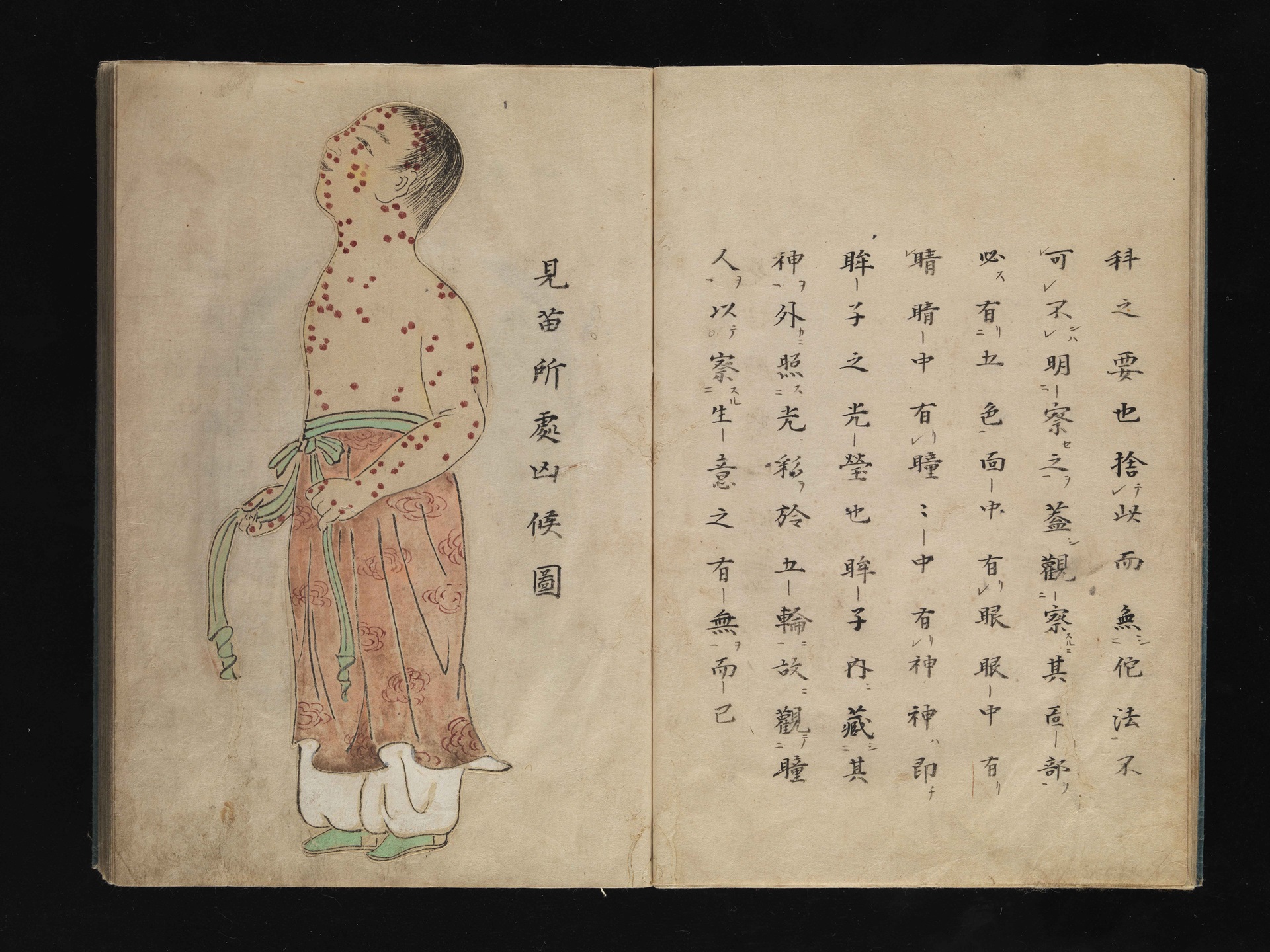 Smallpox-1720-Japan-Illustration Ancient Japanese illustration of smallpox