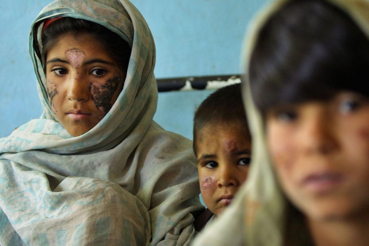 Cutaneous_Leish_GettyImages-51094140 Two young girls and a boy with scars on their faces, caused by Leishmaniasis