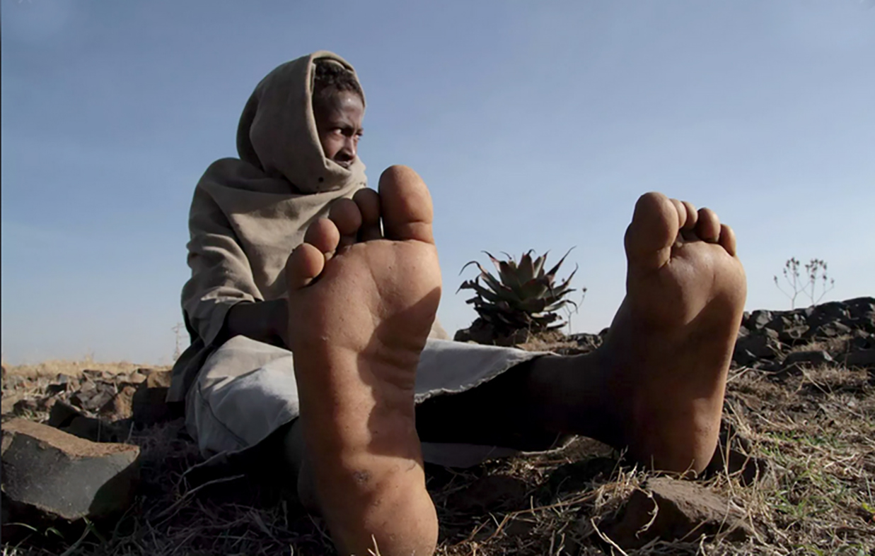 Preventing-Mycetoma-Sudan-2019 Preventing-Mycetoma-Sudan-2019