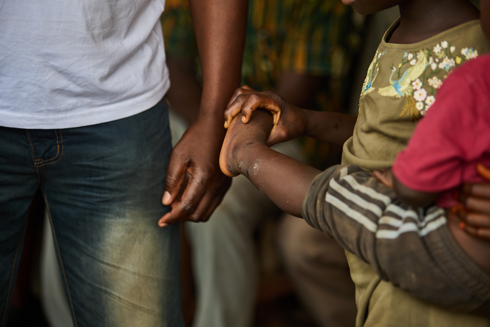 Activities on skin-related NTDs in sub-Saharan Africa-2 A mother with her son at a district health center getting diagnosed for a skin-related NTDs in sub-Saharan Africa